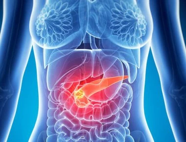 Καρκίνος στο πάγκρεας: Πόσο μεγάλο ρόλο παίζουν τα περιττά κιλά στην εφηβεία